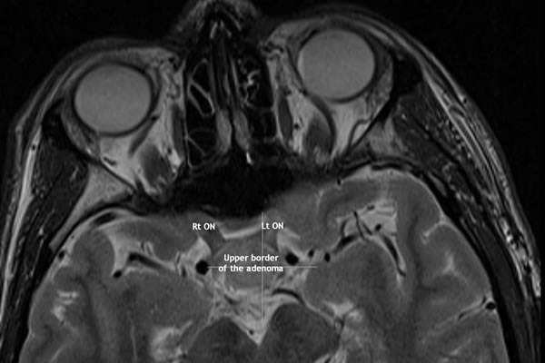 MRI of the sella TW2 axial