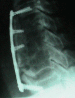 Cervical X-ray: Lateral view.