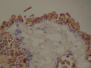 Cytokeratin: positive on the lining cells.