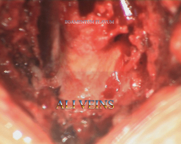 Veins of Ali -A good marker for safe drilling in the medial walls of the facets.