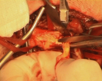 Cutting the atheroma from the ECA.