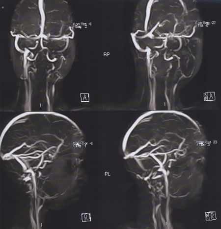 MRV of the head and neck showing absent left JV and SV