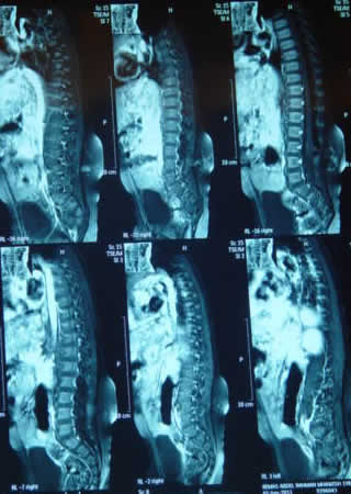 T1W Sagittal MRI with contrast